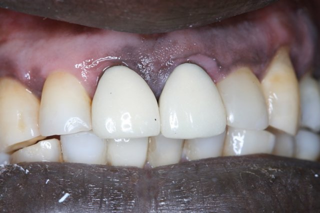 Crowns Before